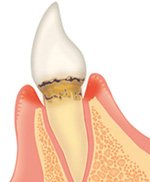 歯周病