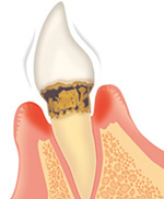 歯周病