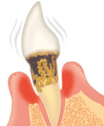 歯周病